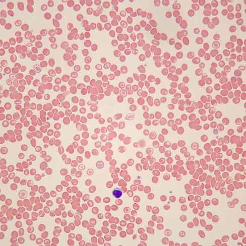 Carolina Human Sickle Cell Anemia Slide, Smear, Wright's Stain in Saudi Arabia