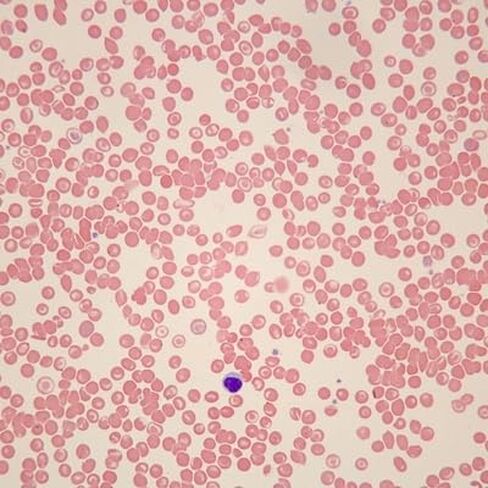 Carolina Human Sickle Cell Anemia Slide, Smear, Wright's Stain in Saudi Arabia