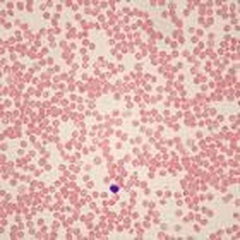 Carolina Human Sickle Cell Anemia Slide, Smear, Wright's Stain in Saudi Arabia