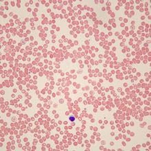 Carolina Human Sickle Cell Anemia Slide, Smear, Wright's Stain in Saudi Arabia