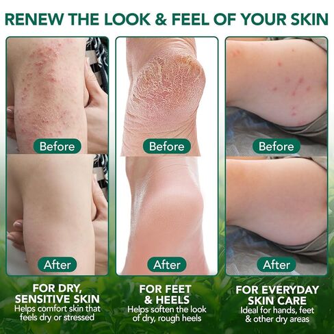 Tea Tree Oil Balm, Tea Tree Oil for Skin, Soothing Balm with Eucalyptus, Aloe, Lavender & Calendula, Soothes Dry, Itchy Skin on Feet, Body & Common Irritated Areas, Intense Moisturizer in Kuwait