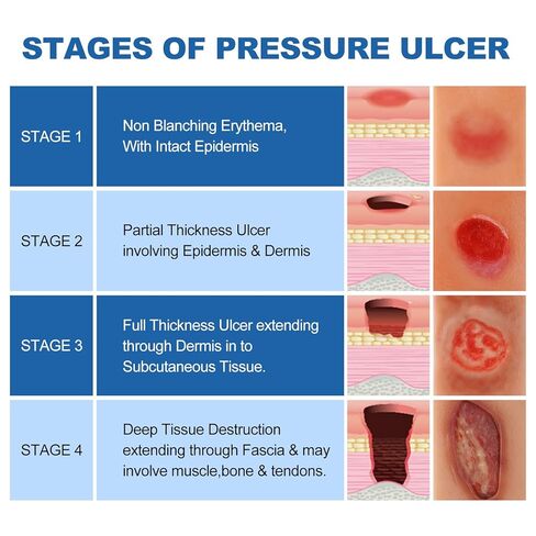 PER4MANCE Pressure Ulcer Wound Model Stages I–IV: Silicone Decubitus Care Training Kit for Nursing Practice & Medical Education in Kuwait