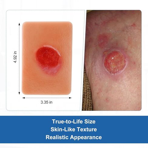 PER4MANCE Pressure Ulcer Wound Model Stages I–IV: Silicone Decubitus Care Training Kit for Nursing Practice & Medical Education in Kuwait