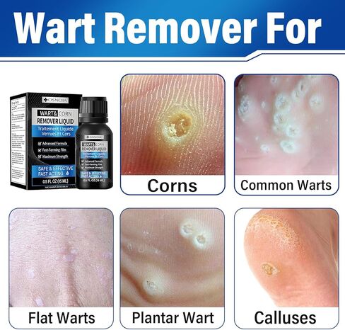 سائل مزيل الثآليل بقوة إضافية مع حمض الساليسيليك بنسبة 17%، علاج سريع المفعول للثآليل الأخمصية والشائعة، مزيل الذرة للقدمين وأصابع القدم 15 مل in Kuwait