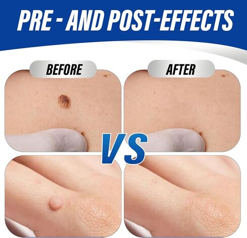 سائل مزيل الثآليل بقوة إضافية مع حمض الساليسيليك بنسبة 17%، علاج سريع المفعول للثآليل الأخمصية والشائعة، مزيل الذرة للقدمين وأصابع القدم 15 مل in Kuwait