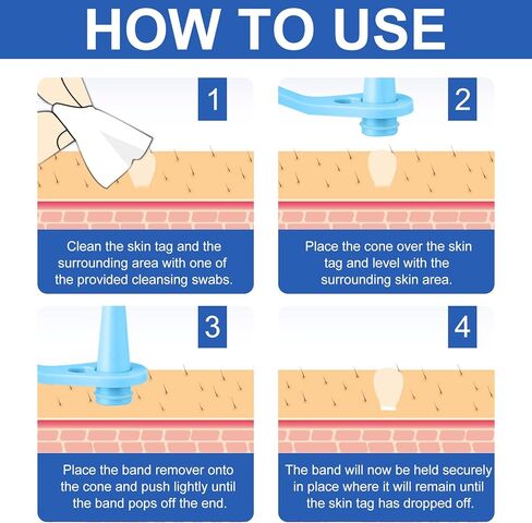 جهاز إزالة الزوائد الجلدية، مجموعة آمنة وفعالة لإزالة الزوائد الجلدية، حاصلة على موافقة إدارة الأغذية والعقاقير (FDA)، للاستخدام المنزلي in Kuwait