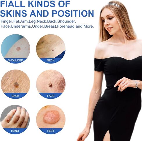 جهاز إزالة الزوائد الجلدية، مجموعة آمنة وفعالة لإزالة الزوائد الجلدية، حاصلة على موافقة إدارة الأغذية والعقاقير (FDA)، للاستخدام المنزلي in Kuwait