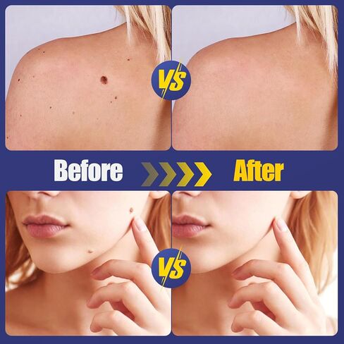 Wart Treatment Patches with 1% Salicylic Acid, Thin Waterproof Hydrocolloid Stickers for Hands & Feet, Discreet Protective Covers, 144 Count in Kuwait