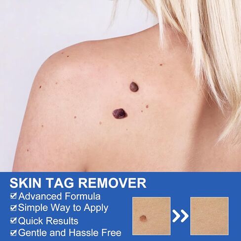 جهاز إزالة الزوائد الجلدية، مجموعة آمنة وفعالة لإزالة الزوائد الجلدية، حاصلة على موافقة إدارة الأغذية والعقاقير (FDA)، للاستخدام المنزلي in Kuwait