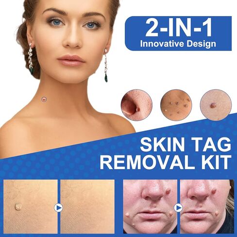 جهاز إزالة الزوائد الجلدية، مجموعة آمنة وفعالة لإزالة الزوائد الجلدية، حاصلة على موافقة إدارة الأغذية والعقاقير (FDA)، للاستخدام المنزلي in Kuwait