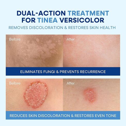 Hermon Tinea Versicolor Treatment Cream & Soap: Clinically Proven Cream for Athlete's Foot,Tinea Versicolor, Jock Itch, Ringworm - Soothes, Cleanses, and Restores Skin Health in Saudi Arabia