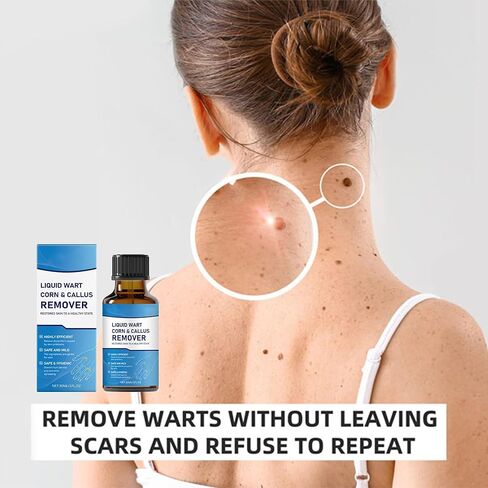 مصل احترافي لإزالة الثآليل والشامات - للوجه والجسم، تركيبة سريعة المفعول لجميع أنواع البشرة والرجال والنساء - 1 أونصة سائلة in Kuwait