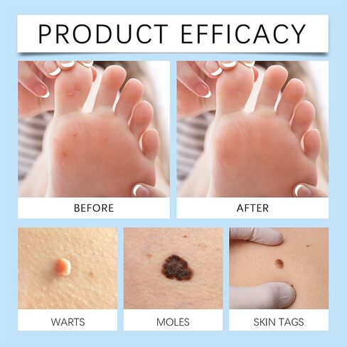 مصل احترافي لإزالة الثآليل والشامات - للوجه والجسم، تركيبة سريعة المفعول لجميع أنواع البشرة والرجال والنساء - 1 أونصة سائلة in Kuwait