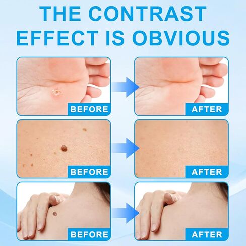 Fast Acting Skin Tag Remover for Face & Body - Salicylic Acid Mole and Wart Removal Pen with Brush I Gentle Formula for Wart Remover, Travel Size (0.085FL.OZ) in Kuwait