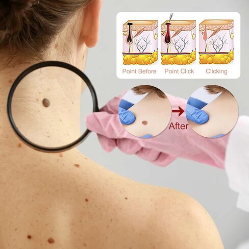 مزيل علامات الشامات من حمض الساليسيليك للوجه والجسم، مصل إزالة الثآليل مع قطارة دقيقة، إزالة الثآليل والشامات سريعة المفعول للثآليل الأخمصية والشائعة والمسطحة، تركيبة لطيفة (قطعتان) in Saudi Arabia