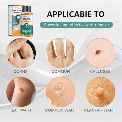 سائل مزيل الثآليل - 12% حمض الساليسيليك - تجميد الثآليل سريع المفعول للثآليل الأخمصية، والثآليل التناسلية، والثآليل الشائعة، والثآليل المسطحة، والذرة، والكالس على أظافر القدم والأظافر - 20 مل in Kuwait