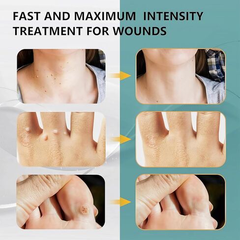 سائل مزيل الثآليل - 12% حمض الساليسيليك - تجميد الثآليل سريع المفعول للثآليل الأخمصية، والثآليل التناسلية، والثآليل الشائعة، والثآليل المسطحة، والذرة، والكالس على أظافر القدم والأظافر - 20 مل in Kuwait