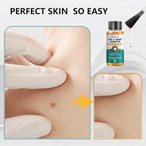 سائل مزيل الثآليل - 12% حمض الساليسيليك - تجميد الثآليل سريع المفعول للثآليل الأخمصية، والثآليل التناسلية، والثآليل الشائعة، والثآليل المسطحة، والذرة، والكالس على أظافر القدم والأظافر - 20 مل in Kuwait