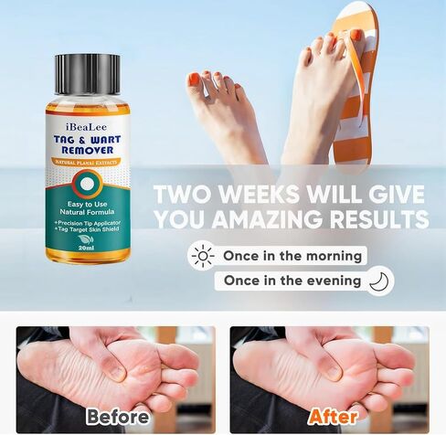 سائل مزيل الثآليل - 12% حمض الساليسيليك - تجميد الثآليل سريع المفعول للثآليل الأخمصية، والثآليل التناسلية، والثآليل الشائعة، والثآليل المسطحة، والذرة، والكالس على أظافر القدم والأظافر - 20 مل in Kuwait