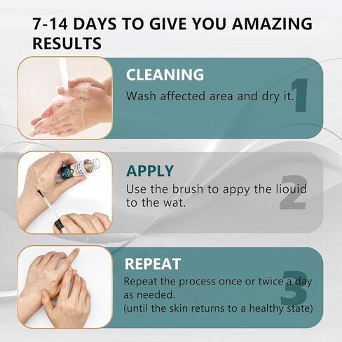 سائل مزيل الثآليل - 12% حمض الساليسيليك - تجميد الثآليل سريع المفعول للثآليل الأخمصية، والثآليل التناسلية، والثآليل الشائعة، والثآليل المسطحة، والذرة، والكالس على أظافر القدم والأظافر - 20 مل in Kuwait