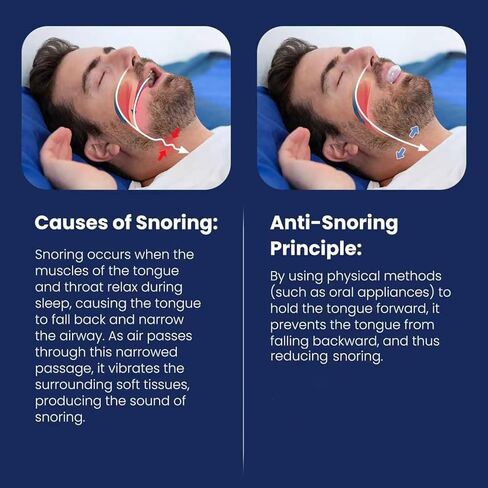 Tongue Stabilizing Device Mouthpiece - Reusable, BPA-Free Anti Snore Solution & Comfortable Tongue Retainer to Reduce Snoring for Better Sleep, Fits Men & Women(White) in Kuwait