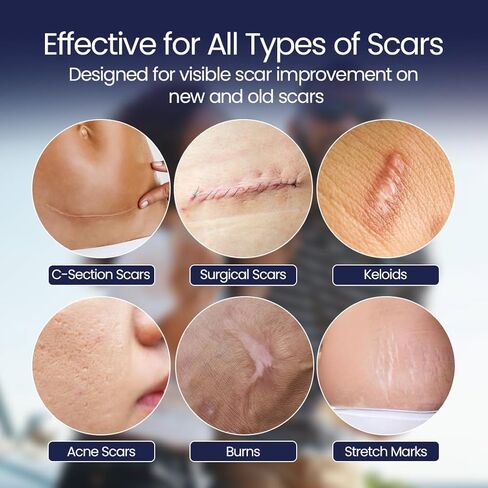 Silicone Scar Patches | Medical-Grade & Hypoallergenic Scar Care for Surgery, C Section Recovery, Keloids, Burns & Stretch Marks | 18 Pre-Cut Flexible Acne Scar Strips in Kuwait