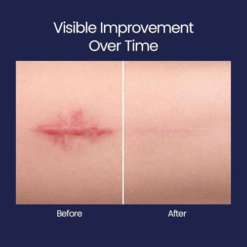 Silicone Scar Patches | Medical-Grade & Hypoallergenic Scar Care for Surgery, C Section Recovery, Keloids, Burns & Stretch Marks | 18 Pre-Cut Flexible Acne Scar Strips in Kuwait