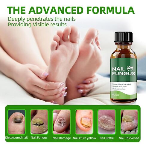 Toenail Fungus Treatment Extra Strength,7Days Nail FungusTreatment for Toenail,7 Pure Natural Plant Extracts,ToeNail Fungus Treatments for Thick, Broken, Discolored & Damaged Nail 1 Fl Oz (Pack of 1) in Saudi Arabia