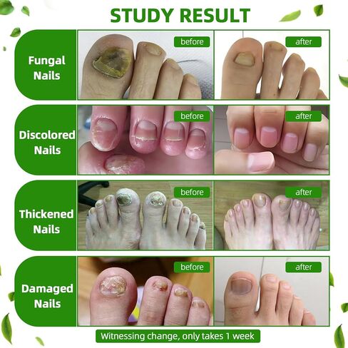 Toenail Fungus Treatment Extra Strength,7Days Nail FungusTreatment for Toenail,7 Pure Natural Plant Extracts,ToeNail Fungus Treatments for Thick, Broken, Discolored & Damaged Nail 1 Fl Oz (Pack of 1) in Saudi Arabia