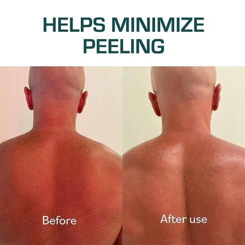 TERNS Mayday Intensive After Sun Gel Cream, Cooling Skin Care for Sunburn Relief, 3X Marine Bioactive Complex with Niacinamide, Squalane, Shea Butter & Aloe, Travel Size, Fragrance Free, 2 Fl Oz in Kuwait