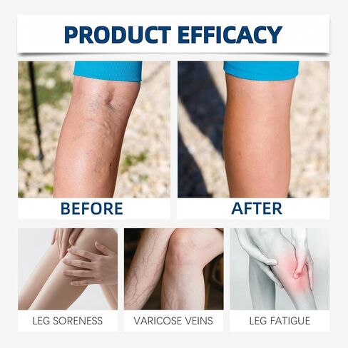 رقعة Vein Target Microdarts، 2026 علاج احترافي جديد لدوالي الأوردة لرقعة الساقين، وتخفيف إزعاج الساق، وتحسين الدورة الدموية، وعلاج الساق بالمكونات الطبيعية لجميع أنواع البشرة. in Kuwait