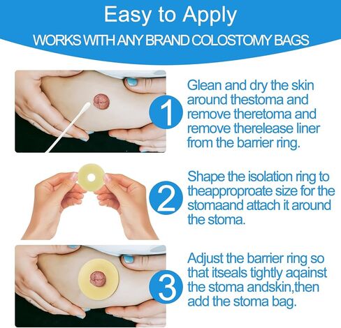 10 PCS Ostomy Barrier Rings - 2mm Thickness Medical Grade Hydrocolloid, Moldable Skin Extender Rings for Leak Prevention, Sensitive Skin, Fits All Ostomy Bags (2 inch Diameter) in Saudi Arabia