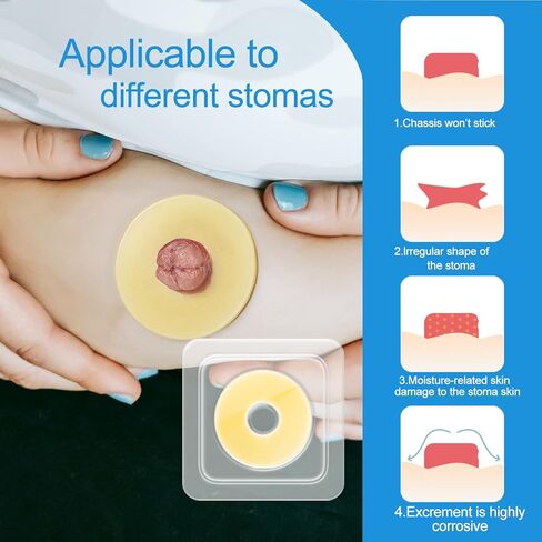 10 PCS Ostomy Barrier Rings - 2mm Thickness Medical Grade Hydrocolloid, Moldable Skin Extender Rings for Leak Prevention, Sensitive Skin, Fits All Ostomy Bags (2 inch Diameter) in Saudi Arabia