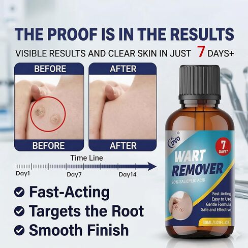 DVO 20% Salicylic Acid Wart Remover Liquid, Maximum Strength Fast-Acting, Painless Wart Removal, Common & Flat Warts, Foot Corn, for Men & Women, 30ML in Saudi Arabia