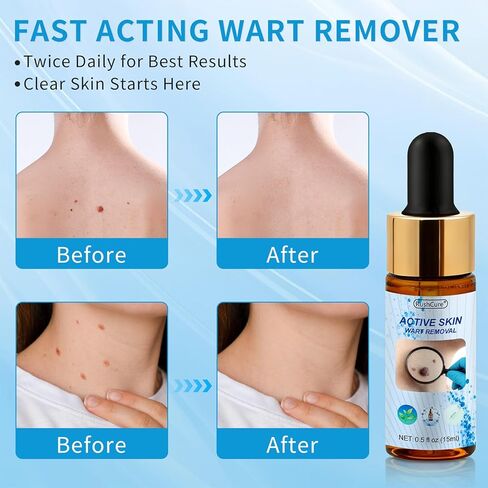 Salicylic Acid Wart Remover for Face & Body - Fast Acting Skin Tag Remover with Precision Dropper, Targets for Corns, Flat, Plantar & Common Warts, Gentle Formula, Travel Size (0.5FL.OZ) in Kuwait