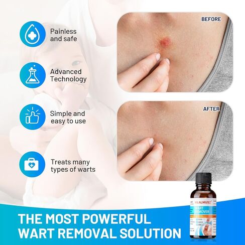 سائل مزيل الثآليل والذرة من هيلموس، 5% حمض الساليسيليك لإزالة الثآليل التناسلية بسرعة على القدمين والقدمين، أفضل منتجات الإزالة الليلية للرجال والأطفال. in Kuwait