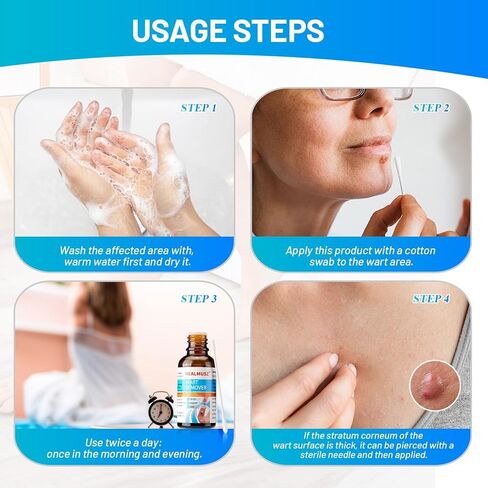 سائل مزيل الثآليل والذرة من هيلموس، 5% حمض الساليسيليك لإزالة الثآليل التناسلية بسرعة على القدمين والقدمين، أفضل منتجات الإزالة الليلية للرجال والأطفال. in Kuwait