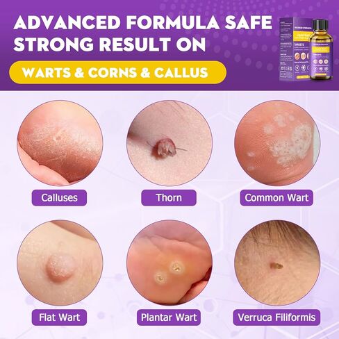 مزيل الثآليل، مجموعة فعالة لإزالة علامات الجلد، إزالة لطيفة للثآليل الشائعة، والثآليل الأخمصية، والذرة والنسيج، سريع المفعول للرجال والنساء (30 مل) in Kuwait