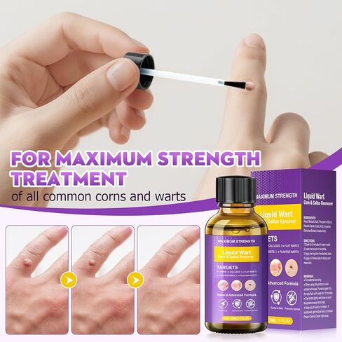 مزيل الثآليل، مجموعة فعالة لإزالة علامات الجلد، إزالة لطيفة للثآليل الشائعة، والثآليل الأخمصية، والذرة والنسيج، سريع المفعول للرجال والنساء (30 مل) in Kuwait