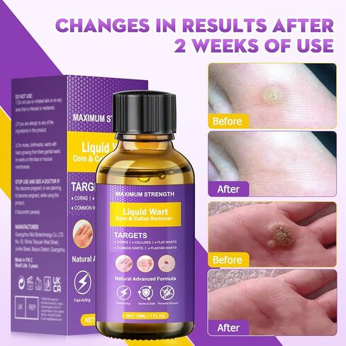 مزيل الثآليل، مجموعة فعالة لإزالة علامات الجلد، إزالة لطيفة للثآليل الشائعة، والثآليل الأخمصية، والذرة والنسيج، سريع المفعول للرجال والنساء (30 مل) in Kuwait