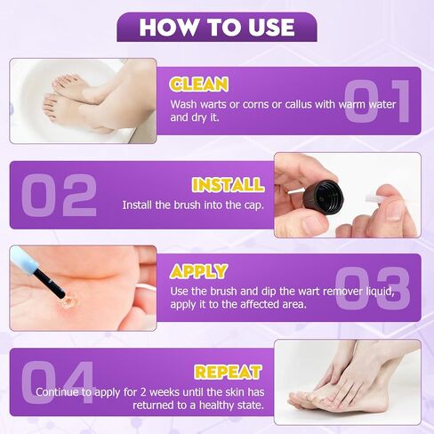 مزيل الثآليل، مجموعة فعالة لإزالة علامات الجلد، إزالة لطيفة للثآليل الشائعة، والثآليل الأخمصية، والذرة والنسيج، سريع المفعول للرجال والنساء (30 مل) in Kuwait