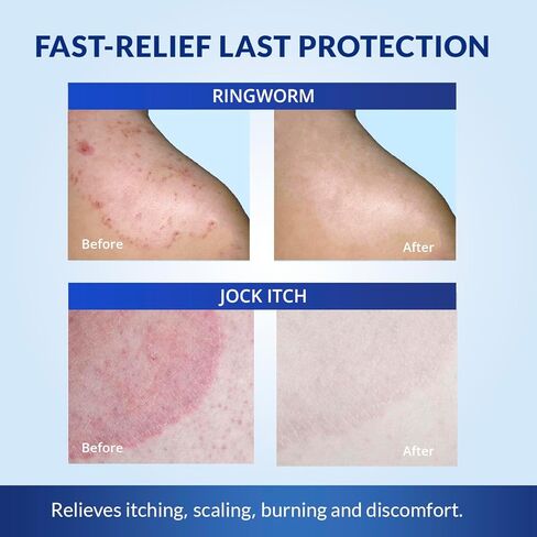 TAGRID NDC-Approved 1% Clotrimazole Antifungal Cream: Powerful, Non-Prescription Relief for Ringworm, Athlete's Foot, and Jock Itch - 50g in Kuwait