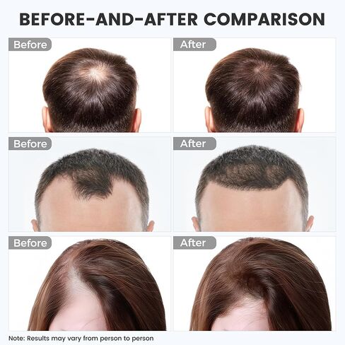 العلاج بالضوء الأحمر لنمو الشعر: غطاء تسخين لاسلكي بالضوء الأحمر مع بطارية قابلة لإعادة الشحن بقدرة 2000 مللي أمبير في الساعة، أداة عناية محمولة للاستخدام المنزلي للرجال والنساء in Kuwait