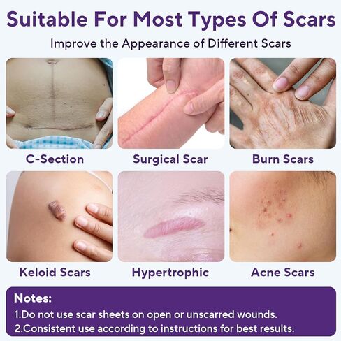 Silicone Scar Sheets, Silicone Scar Tape (1.6"x 60" Roll-1.5m), Advanced Scars Strips for Surgical, C-Section, Tummy Tuck, Burn, Hypertrophic, Keloid Bump Removal Treatment, Reusable in Kuwait