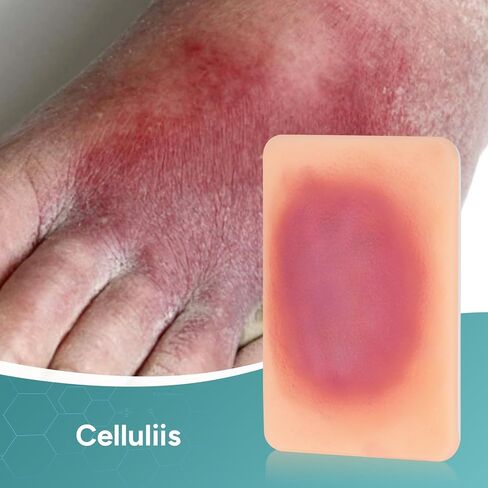 Wound Packing Trainer, Bacterial Infected Wound Model, Palm Sized Wound Simulation Models for Medical Education, Wound Care Demonstrations Tool, 4PCS in Kuwait