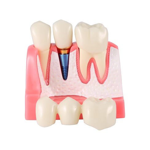 Dental Model 4 Times Dental Implant Teeth Demo Model with Removable Crown and Bridge for Teaching and Studying in Kuwait