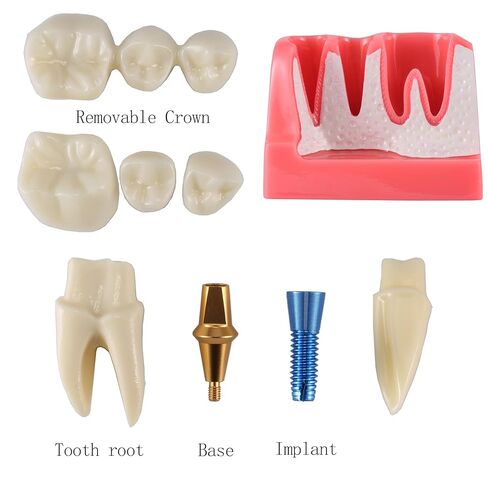 Dental Model 4 Times Dental Implant Teeth Demo Model with Removable Crown and Bridge for Teaching and Studying in Kuwait