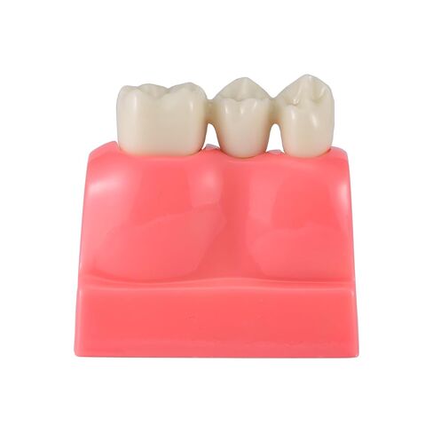 Dental Model 4 Times Dental Implant Teeth Demo Model with Removable Crown and Bridge for Teaching and Studying in Kuwait