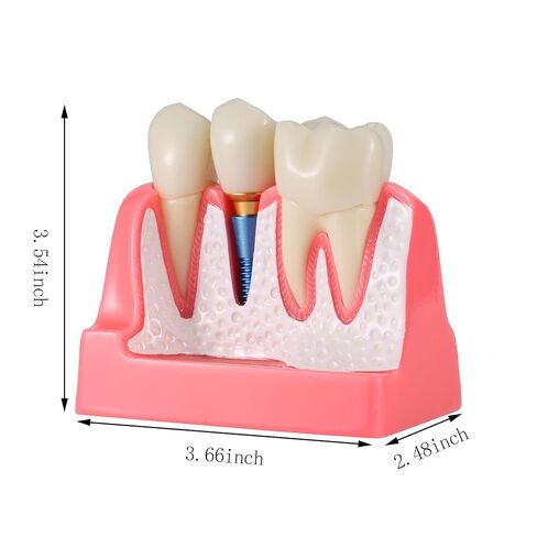 Dental Model 4 Times Dental Implant Teeth Demo Model with Removable Crown and Bridge for Teaching and Studying in Kuwait