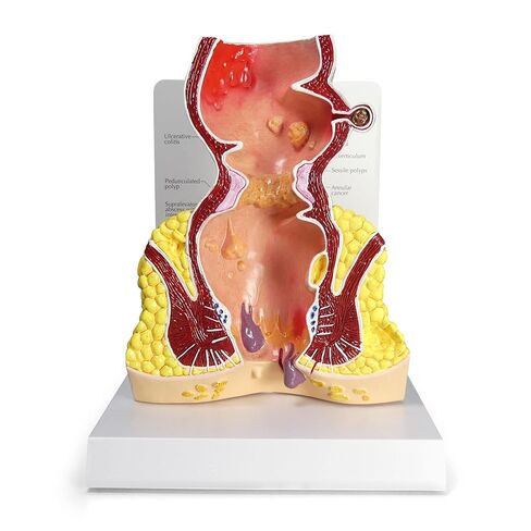 GPI Anatomicals - Human Rectum Model with Common Pathologies, Replica for Anatomy and Physiology Education, Anatomy Model for Doctor's Offices and Classrooms, Medical Learning Resources in Kuwait